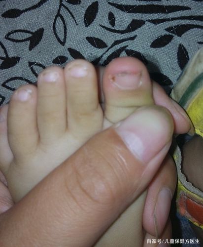 绝大多数宝宝都表为大脚趾上翘,有的一侧,有的双侧;极少数在其它脚趾