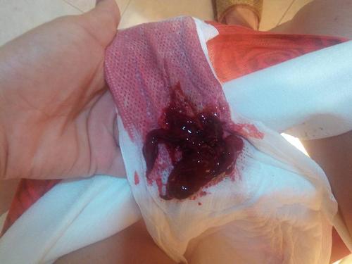 周国军 主治医师 上个月十八号来的月经 这个月2号9号同房 有措施 但