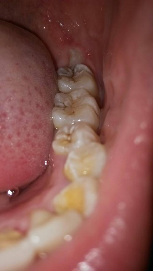 问:请问这样的智齿要拔吗?不痛,要用力舔才有一点感觉.