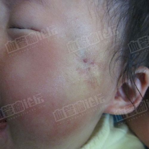 来自沈雅面部混合型血管瘤患者日记