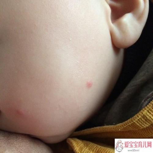 宝宝脸上起红疙瘩怎么回事 宝宝脸上起红疙瘩怎么办