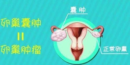 卵巢囊肿连续三年体检无变化一手术却发现成了恶性肿瘤患者