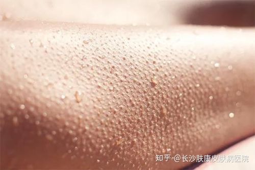 皮肤病课堂鸡皮肤毛周角化症