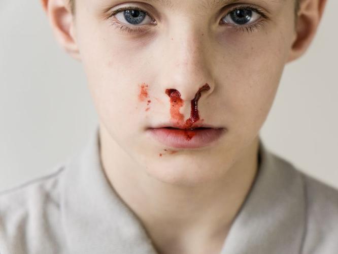 孩子鼻子出血要注意一些什么