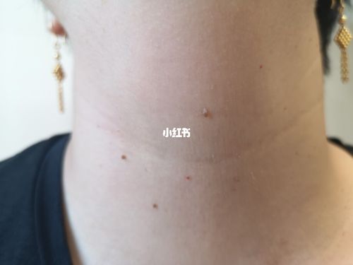 前面这例是丝状疣,后面的这些才是皮赘,同样常见于颈部,长的也很像