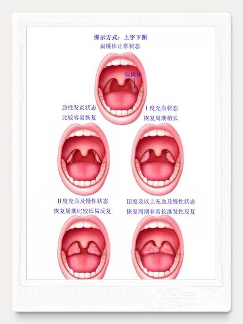 写美篇          检查可见扁桃体慢性充血,扁桃体表面不平,瘢痕,与