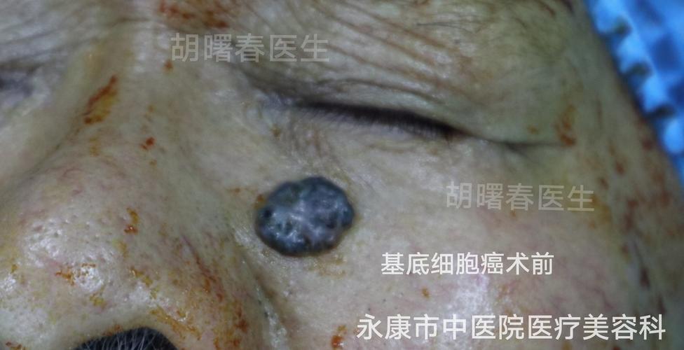 (副本) 写美篇 皮肤恶性肿瘤的治疗效果与其早期诊断密切相关,应注意