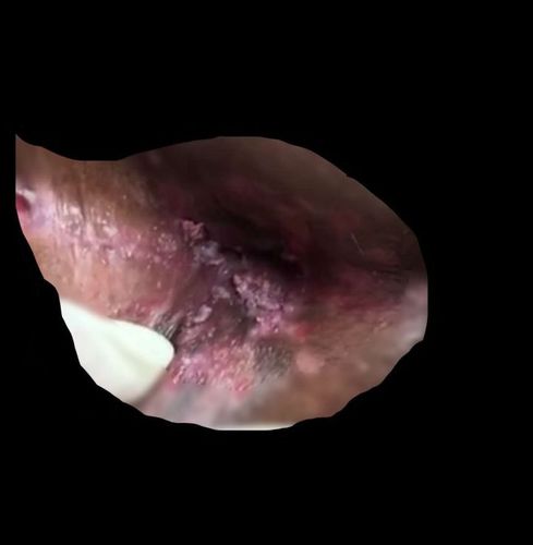 那么尖锐湿疣究竟是什么病呢? 尖锐湿疣是感染hpv