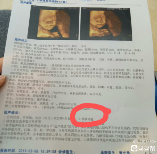 24周时四维医生说宝宝的单脐动脉吓死我