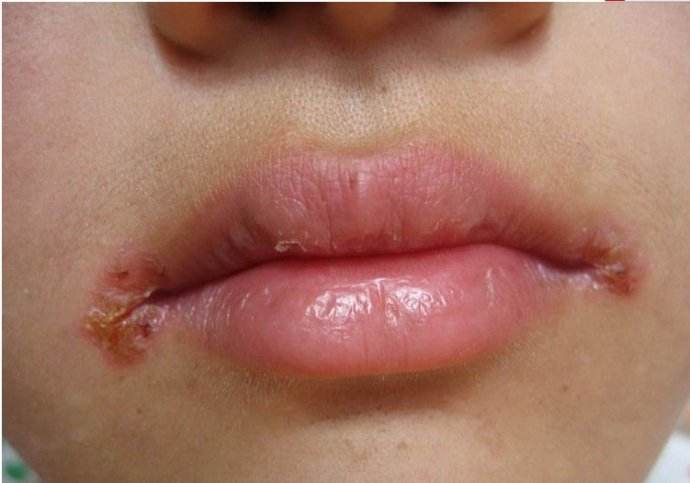 口炎 病因     嘴角长疮即指口角生疮,多见于小儿.亦即口吻疮.