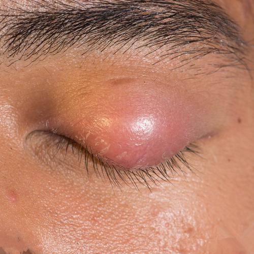 麦粒肿是什么原因造成的看了不该看的东西吗