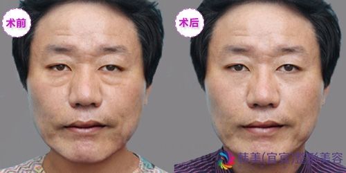 除皱前后效果对比图
