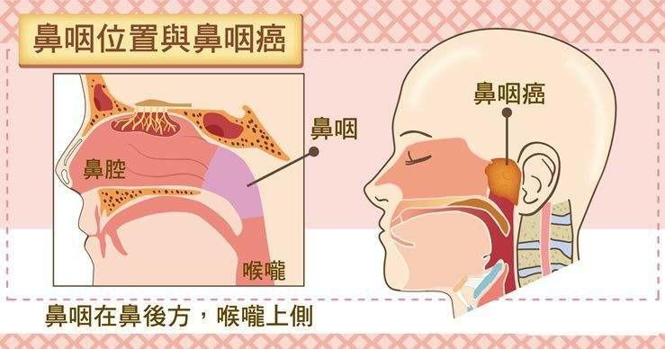 鼻咽癌是指发生于鼻咽腔顶部和侧壁的恶性肿瘤.