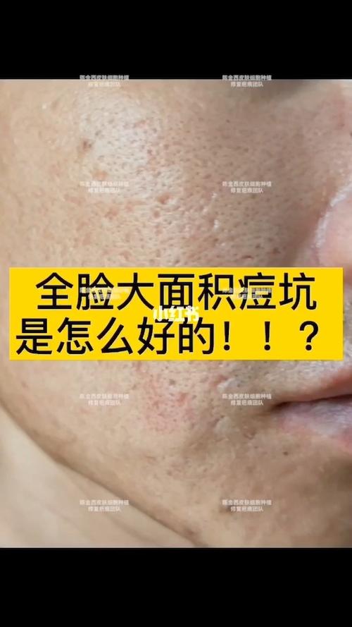 痤疮_疤痕_痘坑