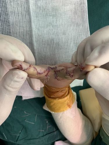 并指矫形手术还是推荐田晓菲教授的双翼皮瓣