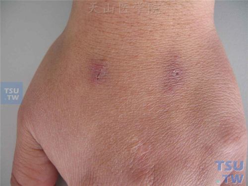 白塞病(bechet disease)症状表现