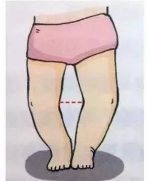 宝宝天生罗圈腿,看这里让宝宝变成大长腿!