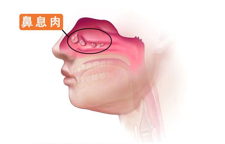 鼻息肉的症状及危害