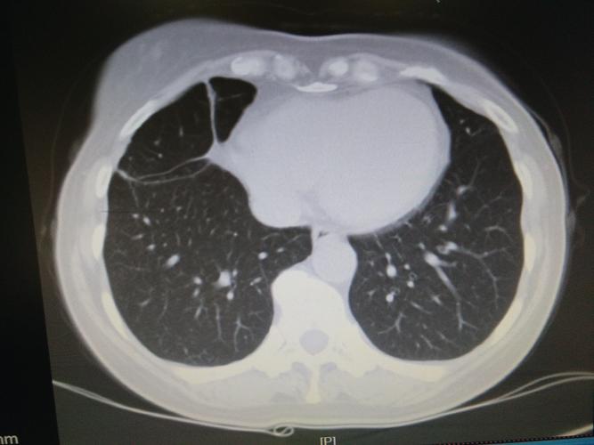 肺部感染,肺结核,高血压一例