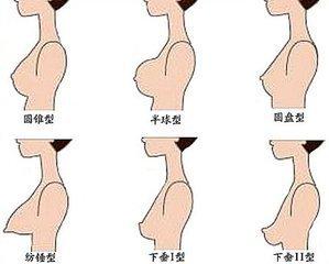 杭州问题乳房矫正乳房下垂