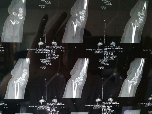 左腕ct可见骨折粉碎移位严重.数条骨折线通过关节面.