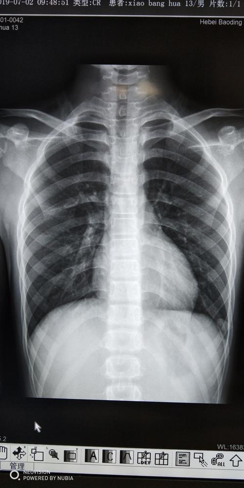 胸片?