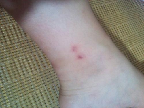 刚刚我的伤口被狗狗轻轻的咬了一下,它是在和我玩,伤口也是已经愈合了