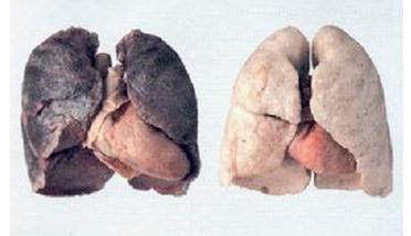 矽肺病危害严重 正规医院治疗更可靠