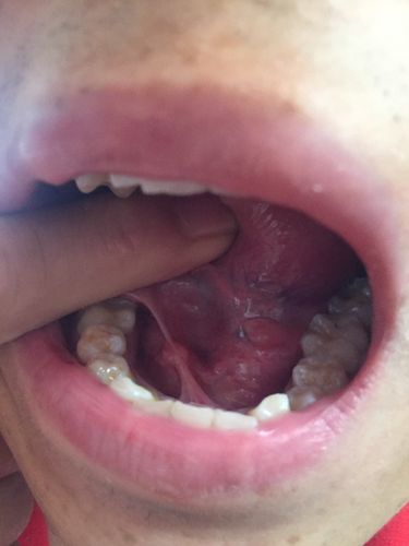 舌头下面长了一片小肉 是什么引起的