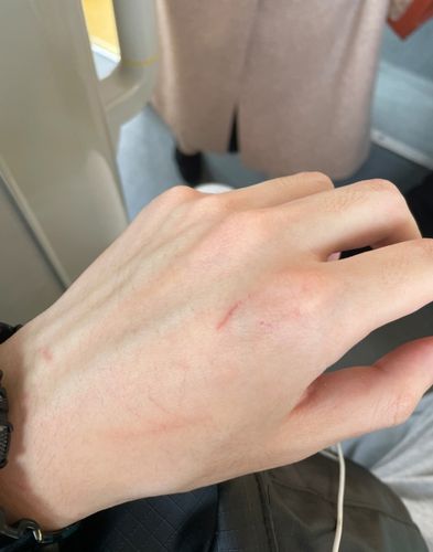 被猫抓伤后及时处理才能不留疤