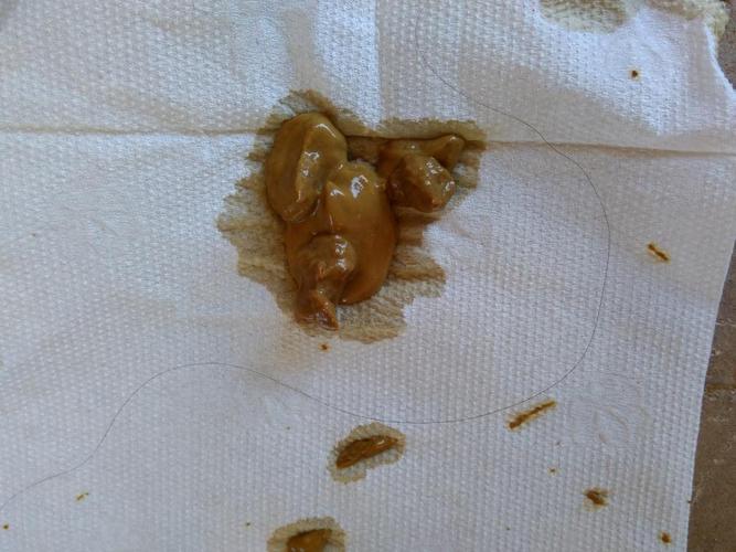 三天拉的糊状,今天直接止不住的拉,一把尿就带出来一点,黄绿色,有奶瓣