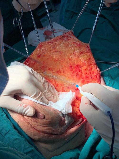 乳腺癌改良根治术