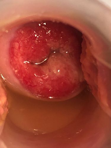 白带不正常导致的宫颈炎和宫颈糜烂需要治疗吗?