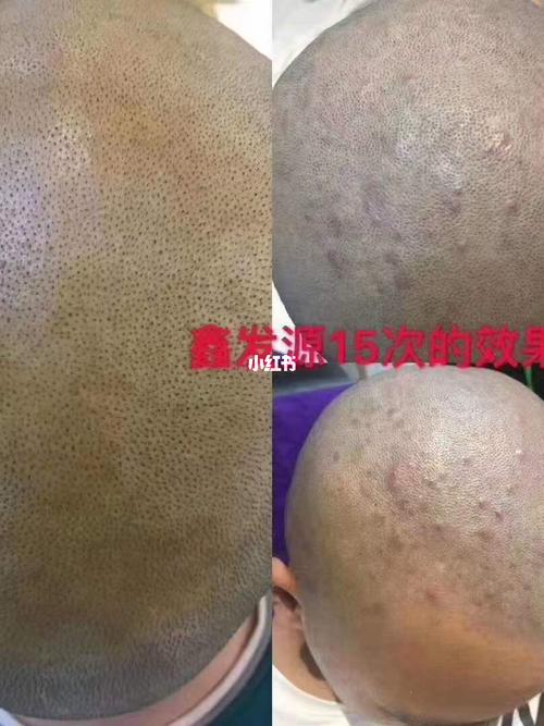 毛囊炎.要对症调理不然会越来越严重_脱发_养发_头皮