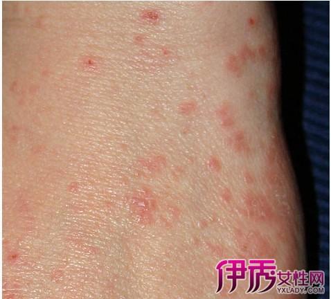 【图】疥疮会自愈吗 3个方法让你远离疥疮困扰