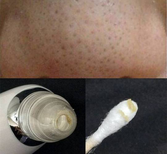 这个厉害了,89块就能把恶心的黑头白头油脂全都吸出来,草莓鼻还等什么