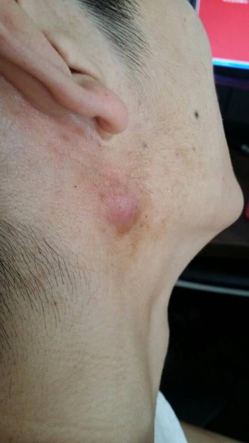 脖子上起了一疙瘩,请问是什么疙瘩,快一个星期了,没见