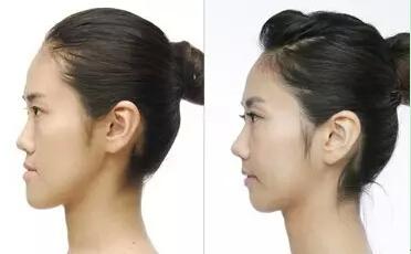 "地包天"会让孩子越来越丑,家长们要注意,别指望长大会自己好