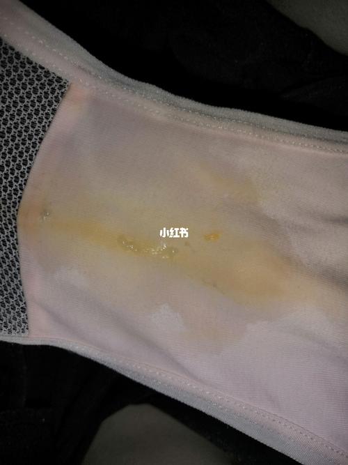 hpv感染,有跟我一样有水样白带的吗?