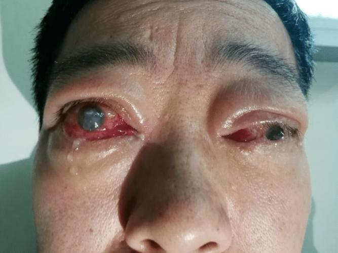 角膜失去眼睑的保护暴露在空气中,出现干燥,上皮脱落,从而继发炎症