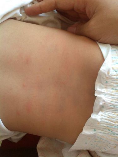 宝宝七个月,过敏了,腿上更多,现在有点像