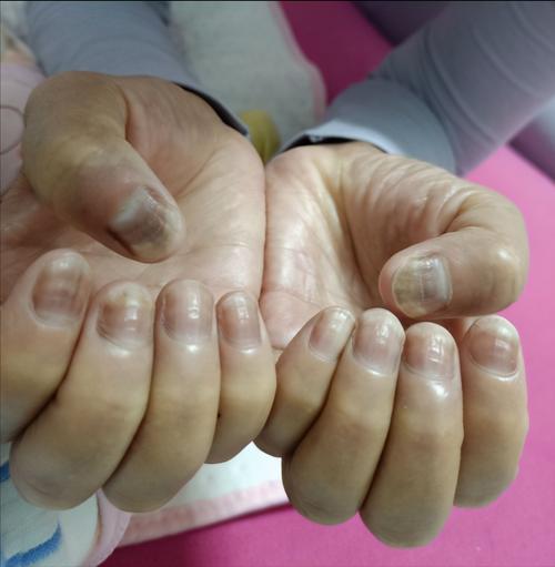 发个指甲变形的图留念下,之前还发黑,现敢伸手让人看了.