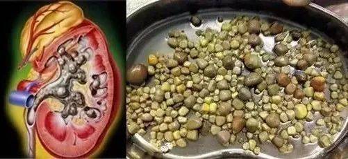 关于肾结石诊治的常见问题