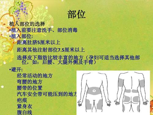 部位 植入部位的选择  植入前要注意洗手,部位消毒  植入部位: 距离