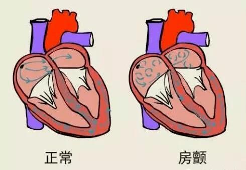 兴图讲坛 | 《房颤的病因及治疗》