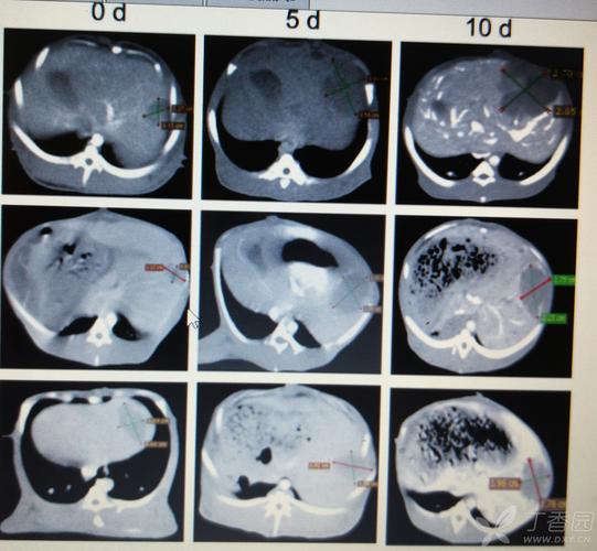 怎么用ct看肿瘤面积呢?