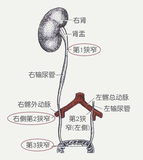 输尿管结石疼得人死去活来这份预防和治疗手册请收好