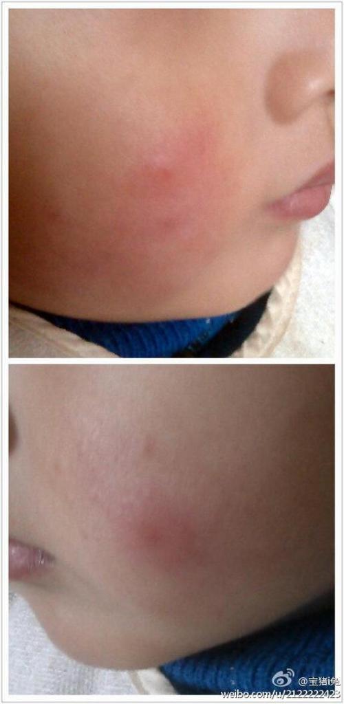 我家宝儿两岁,最近脸