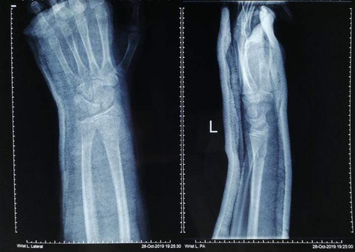 女孩,6岁,轮滑时摔伤 左桡骨下段青枝骨折