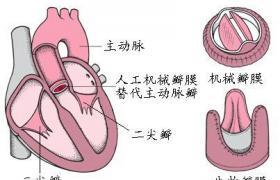 二尖瓣人工瓣膜置换术